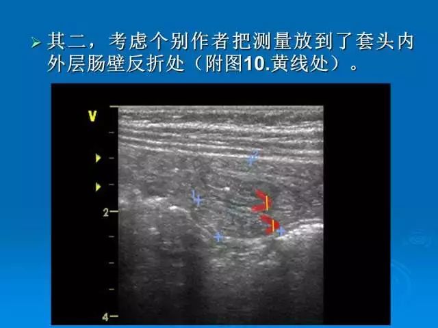 【PPT】小儿急性肠套叠空气灌肠难整复之征象、原因及应对措施