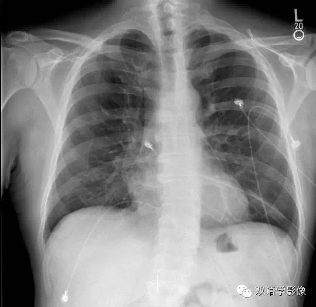 【病例】肺动脉吊带1例CT影像表现 【病例】肺动脉吊带1例CT影像表现