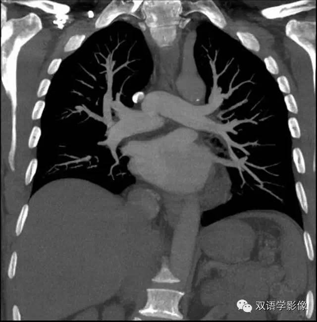 【病例】肺动脉吊带1例CT影像表现 【病例】肺动脉吊带1例CT影像表现