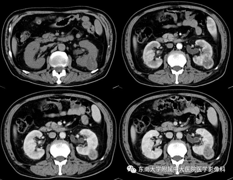【病例】囊性肾癌(左肾透明细胞癌)1例CT影像表现