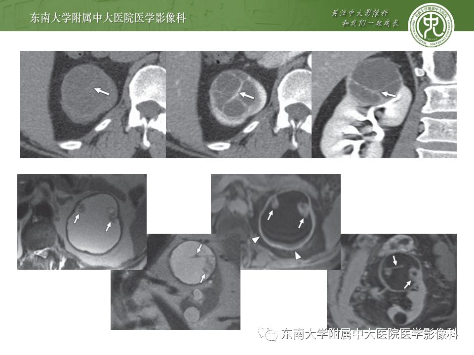 【病例】囊性肾癌(左肾透明细胞癌)1例CT影像表现