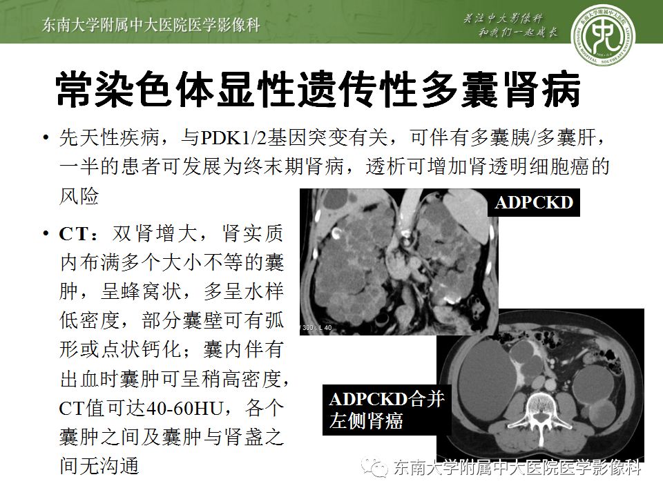 【病例】囊性肾癌(左肾透明细胞癌)1例CT影像表现