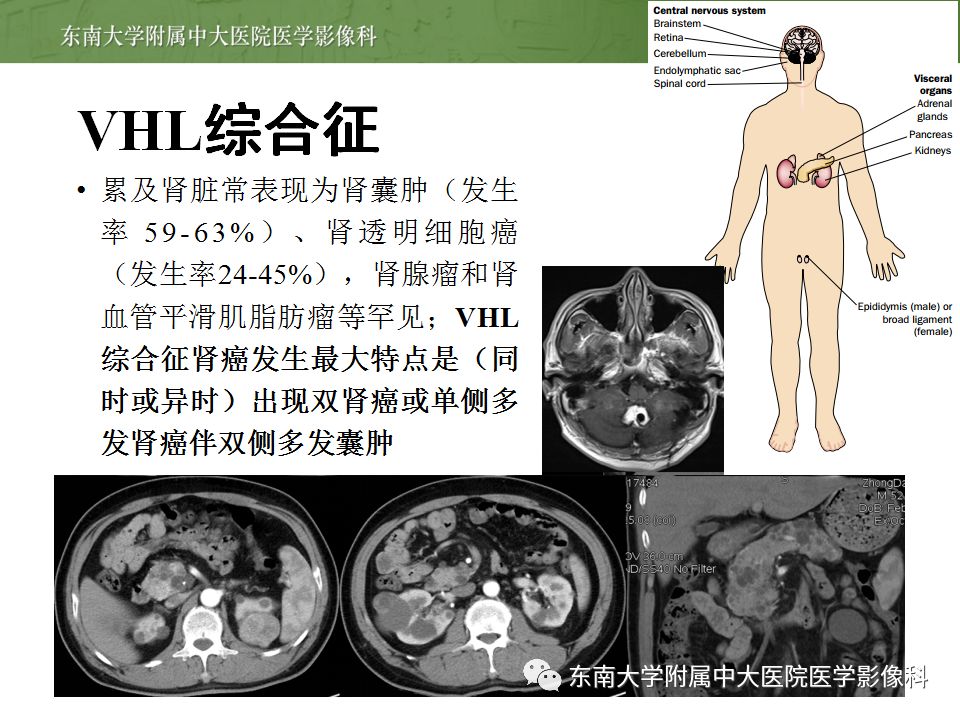 【病例】囊性肾癌(左肾透明细胞癌)1例CT影像表现
