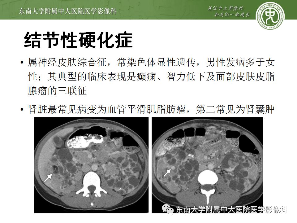 【病例】囊性肾癌(左肾透明细胞癌)1例CT影像表现