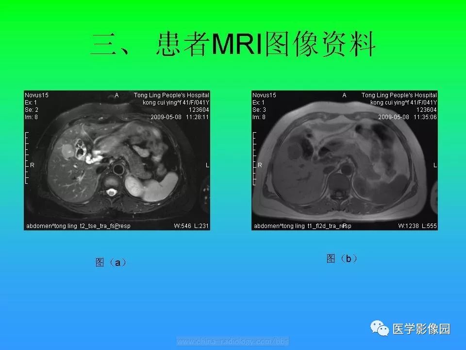 【病例】低分化肝癌1例MR影像表现