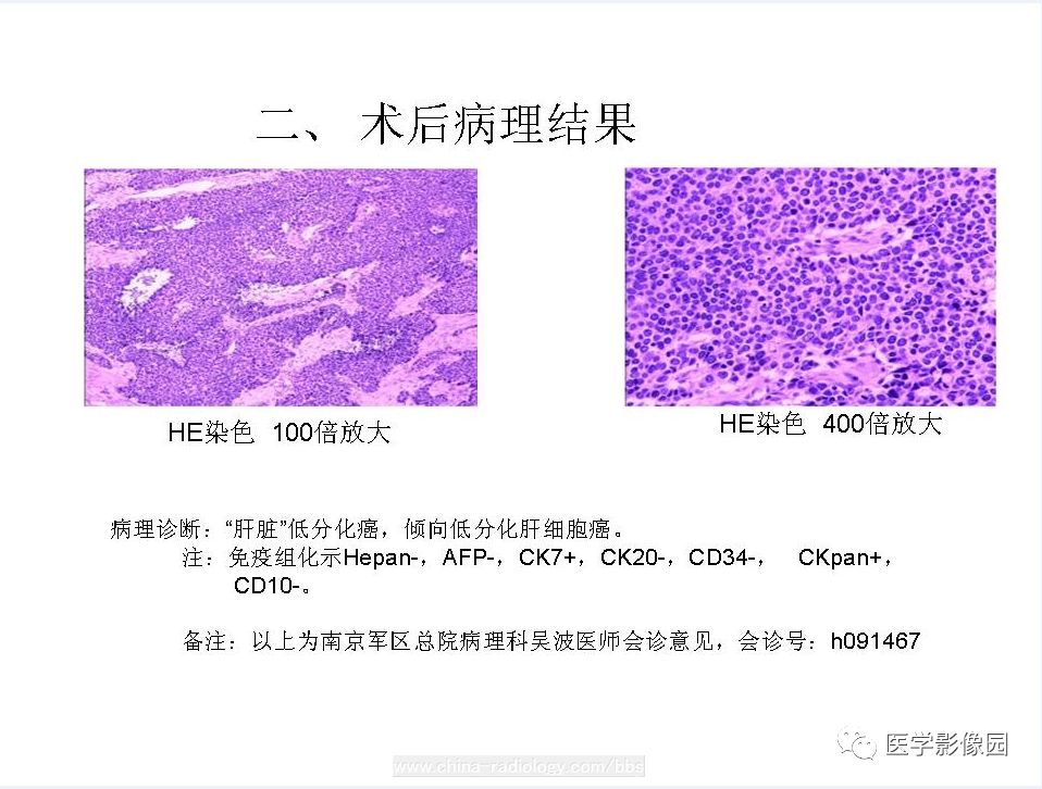 【病例】低分化肝癌1例MR影像表现