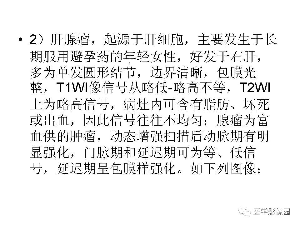 【病例】低分化肝癌1例MR影像表现