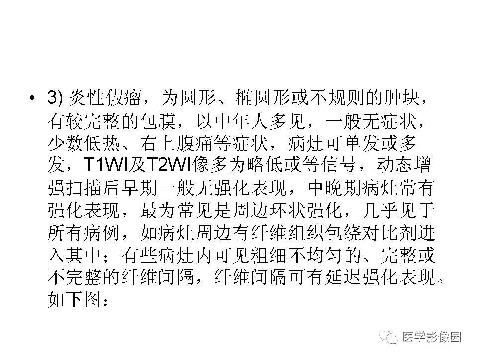 【病例】低分化肝癌1例MR影像表现