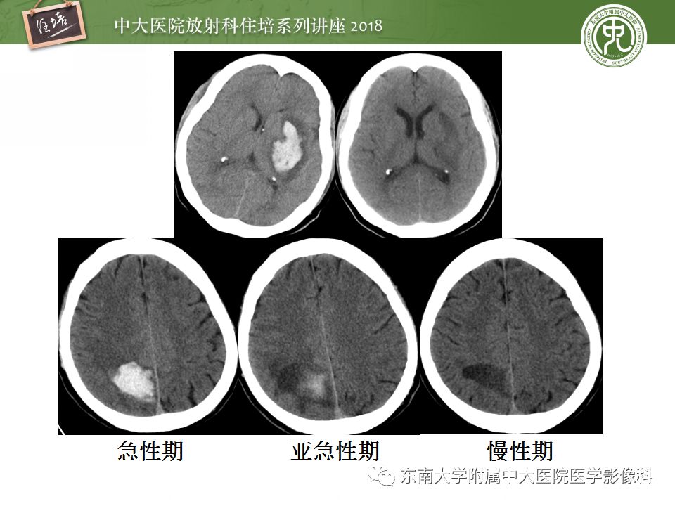 【PPT】脑内出血转归影像学表现