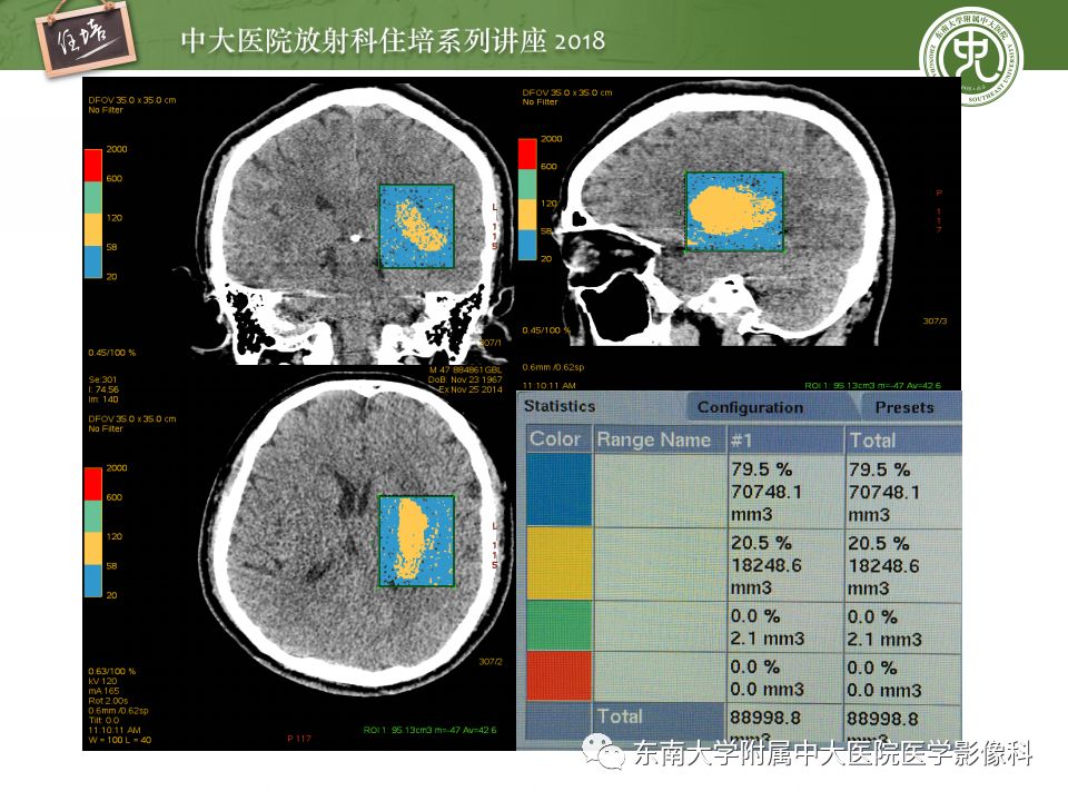 【PPT】脑内出血转归影像学表现