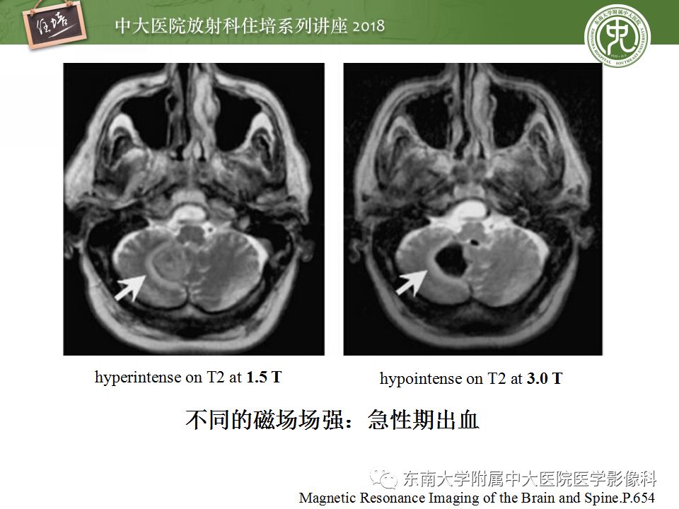 【PPT】脑内出血转归影像学表现