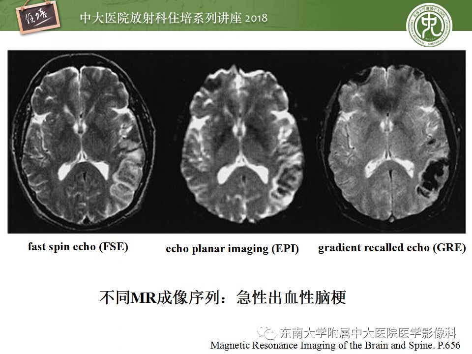 【PPT】脑内出血转归影像学表现