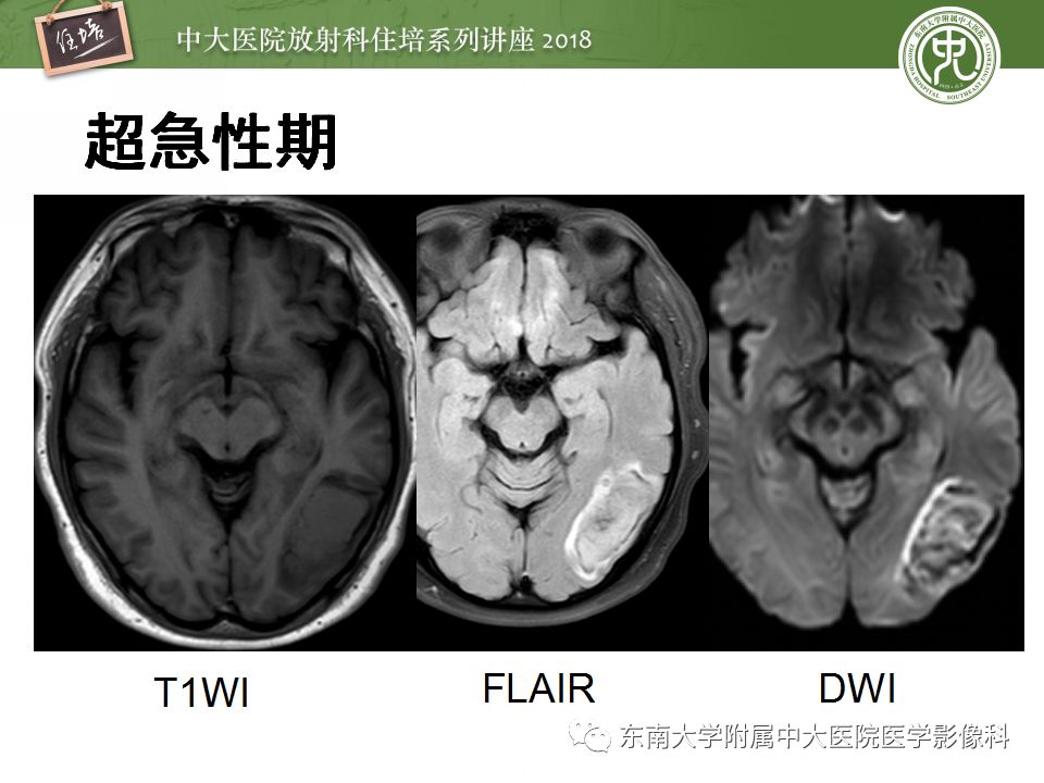 【PPT】脑内出血转归影像学表现