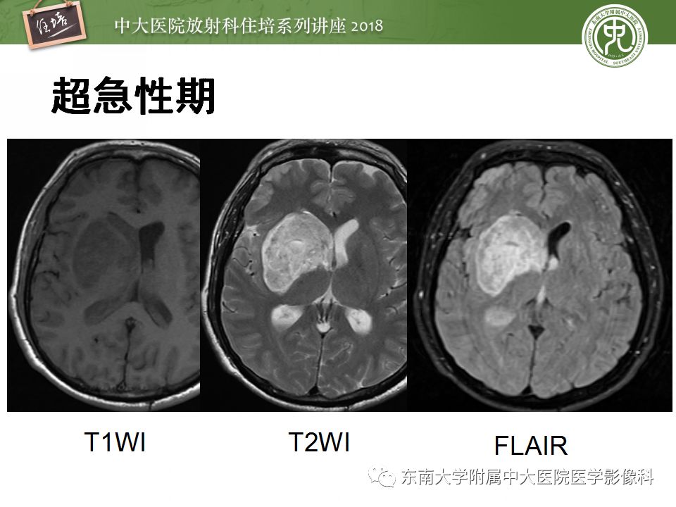 【PPT】脑内出血转归影像学表现