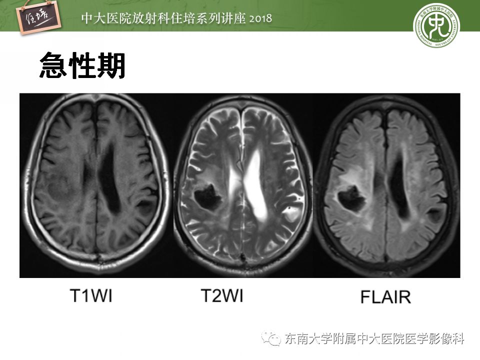 【PPT】脑内出血转归影像学表现