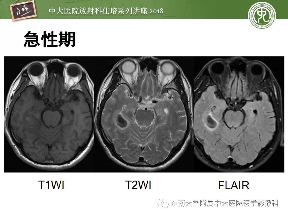 【PPT】脑内出血转归影像学表现