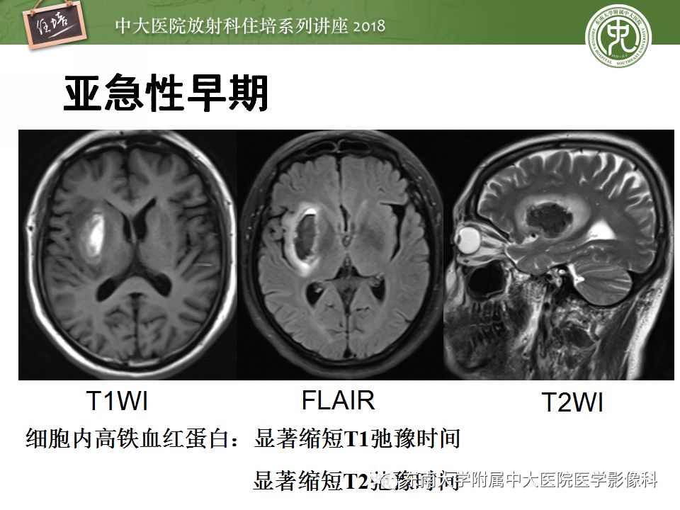 【PPT】脑内出血转归影像学表现