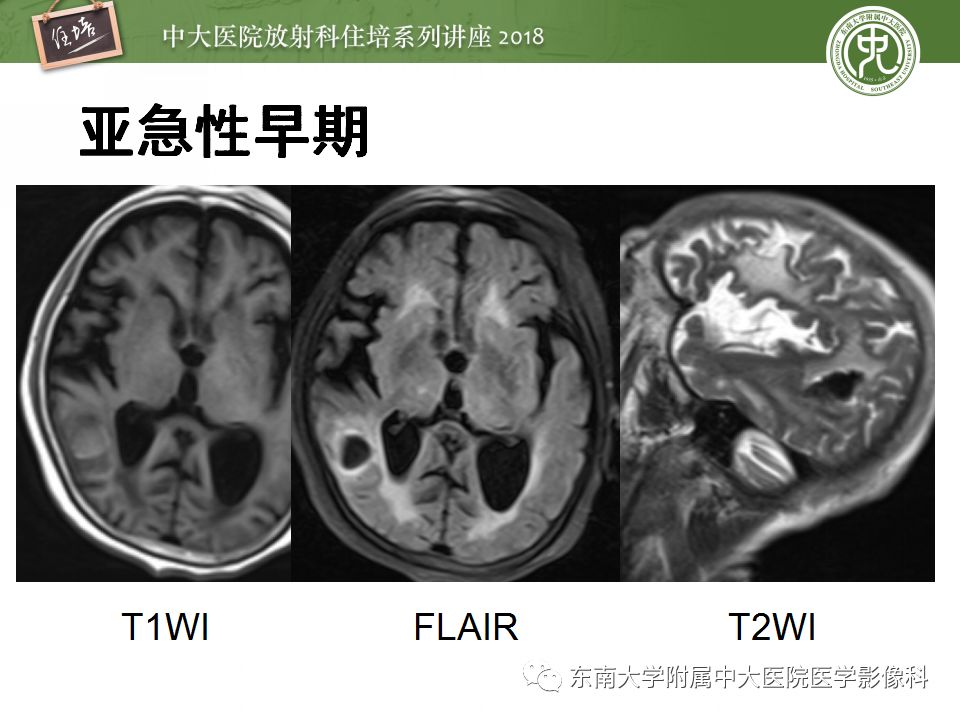 【PPT】脑内出血转归影像学表现