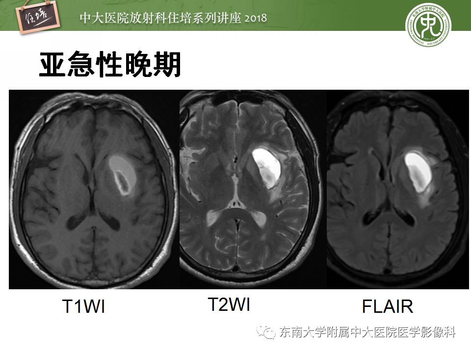 【PPT】脑内出血转归影像学表现