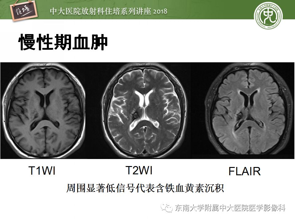 【PPT】脑内出血转归影像学表现