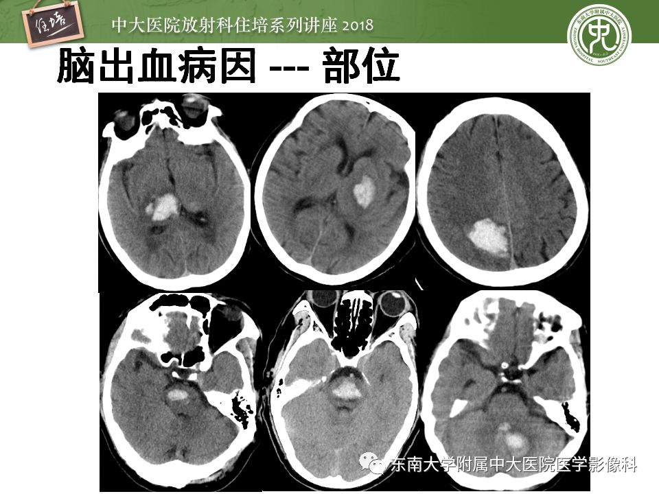 【PPT】脑内出血转归影像学表现