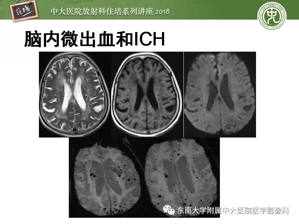【PPT】脑内出血转归影像学表现