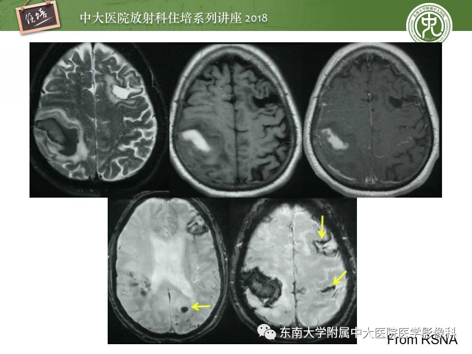 【PPT】脑内出血转归影像学表现
