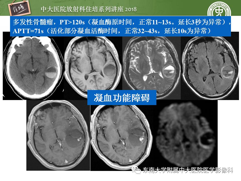 【PPT】脑内出血转归影像学表现