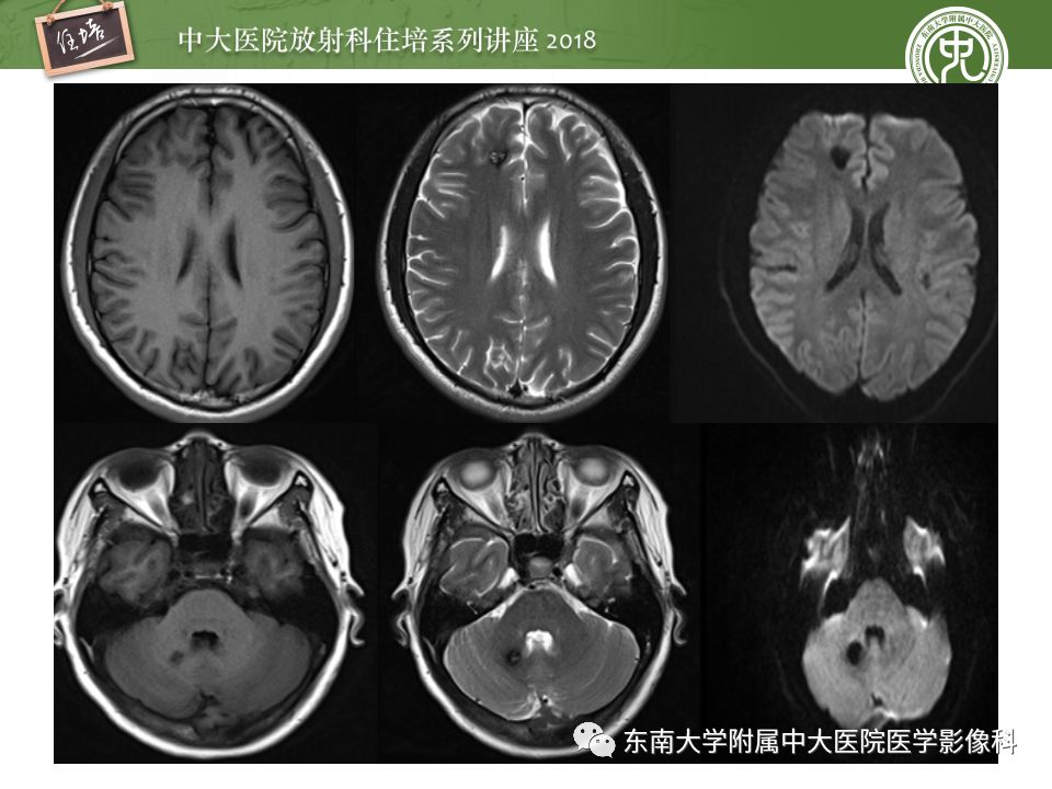【PPT】脑内出血转归影像学表现