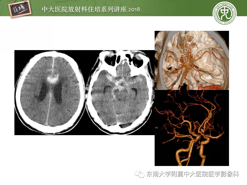 【PPT】脑内出血转归影像学表现
