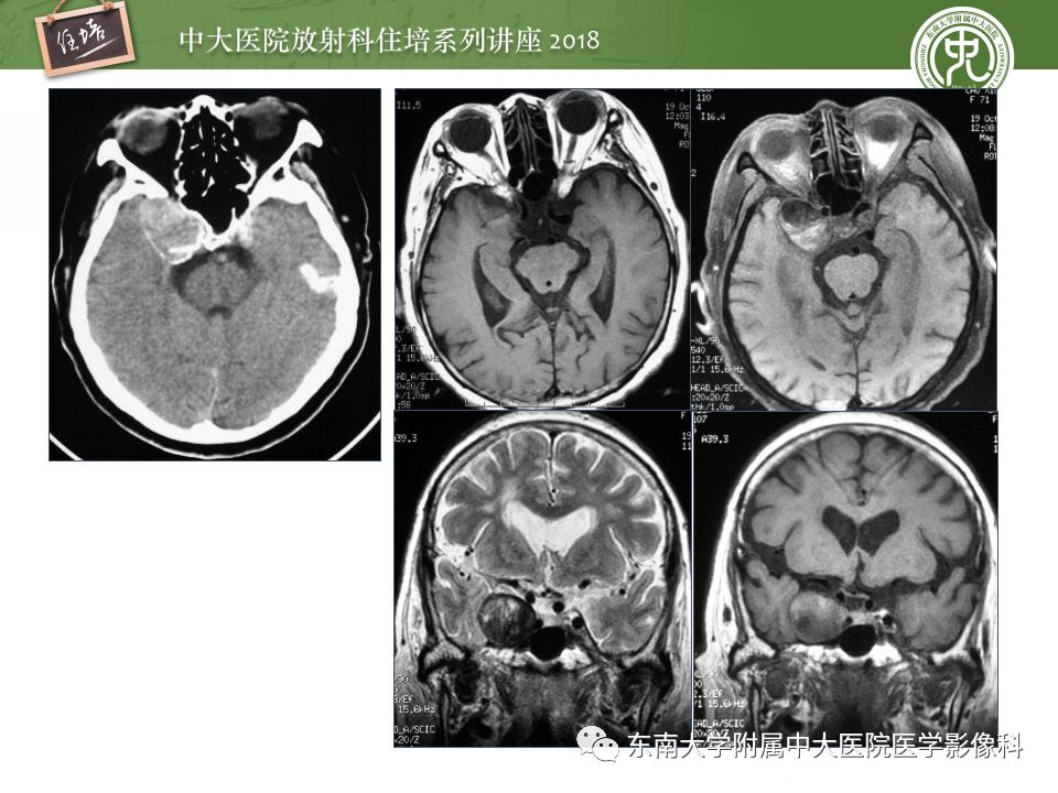 【PPT】脑内出血转归影像学表现