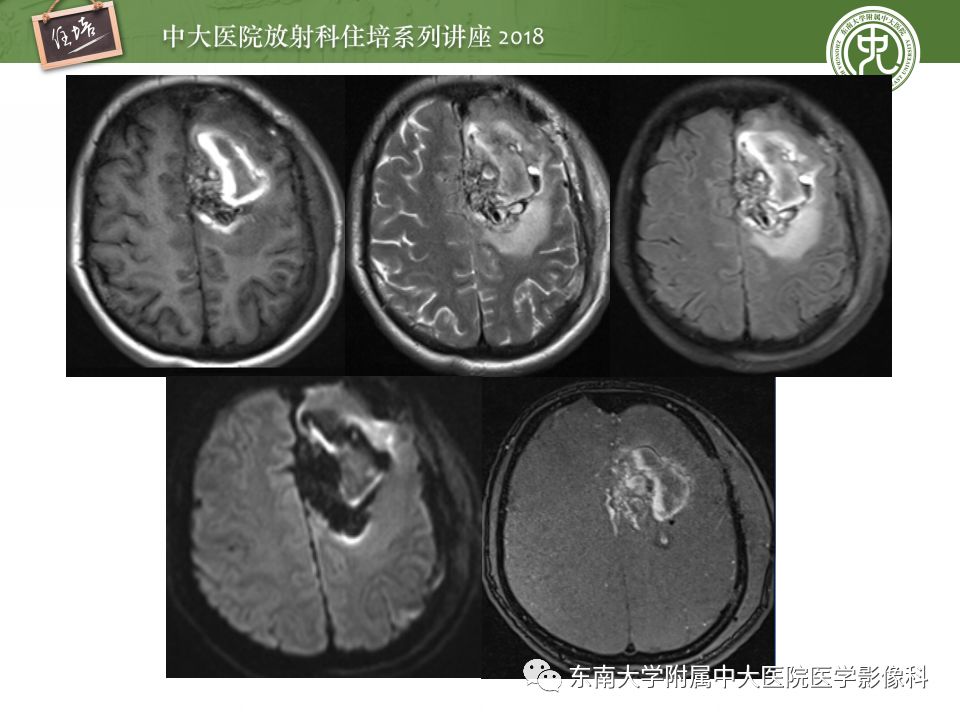 【PPT】脑内出血转归影像学表现