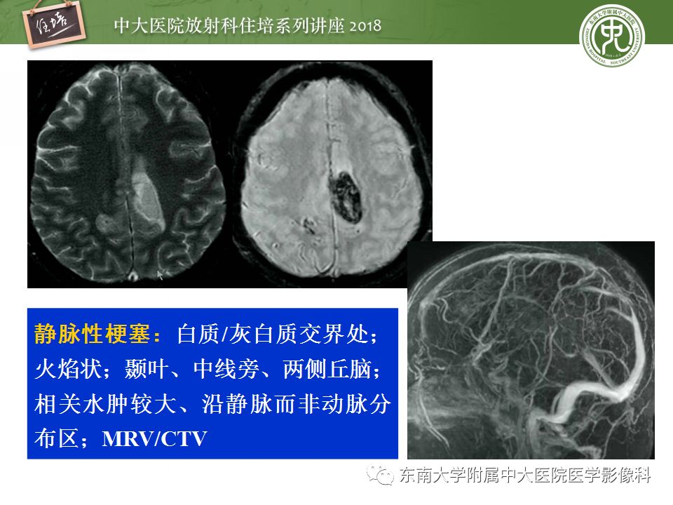 【PPT】脑内出血转归影像学表现