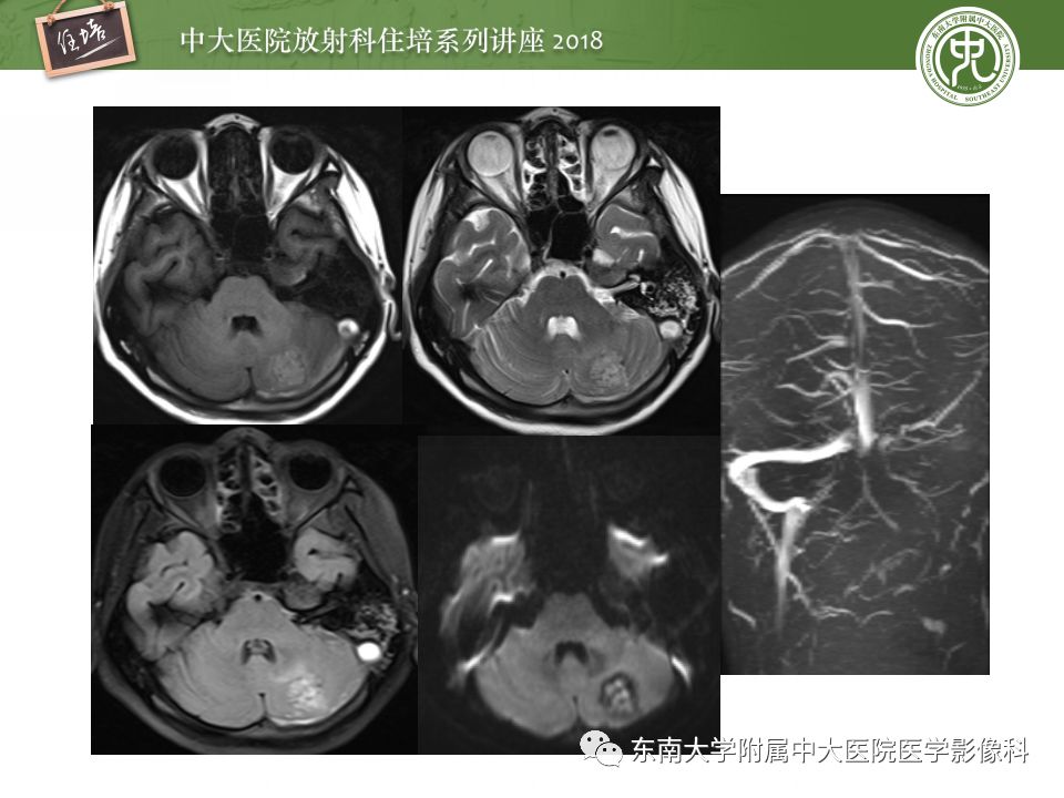 【PPT】脑内出血转归影像学表现
