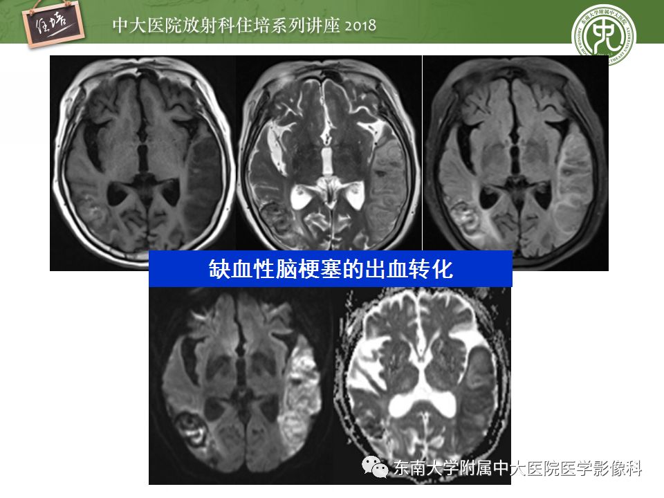 【PPT】脑内出血转归影像学表现