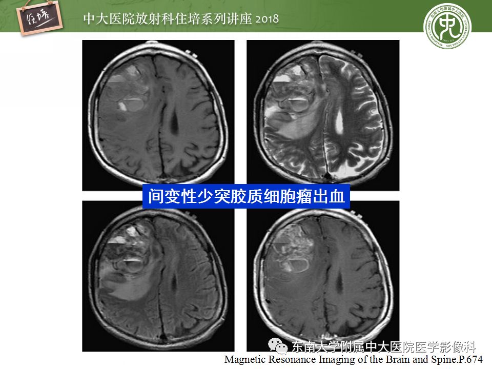 【PPT】脑内出血转归影像学表现