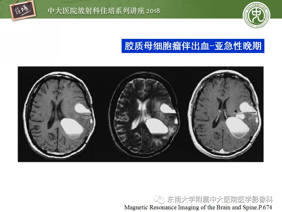【PPT】脑内出血转归影像学表现