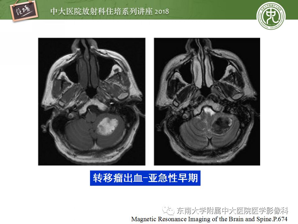 【PPT】脑内出血转归影像学表现