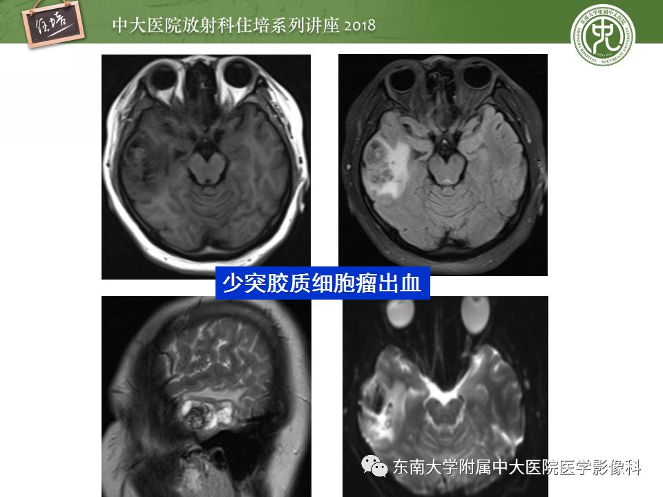 【PPT】脑内出血转归影像学表现