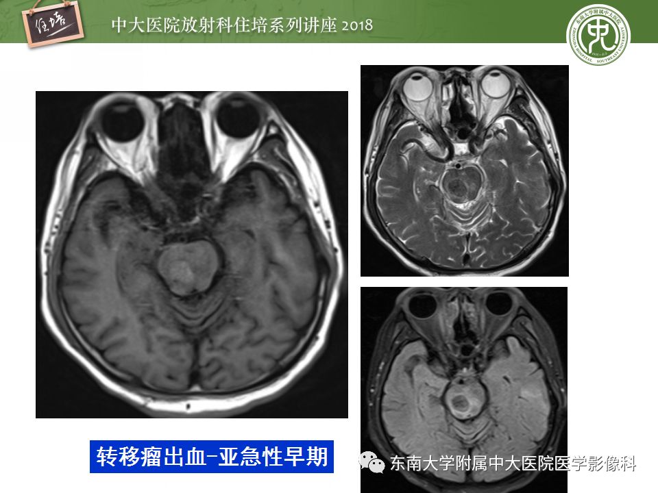 【PPT】脑内出血转归影像学表现
