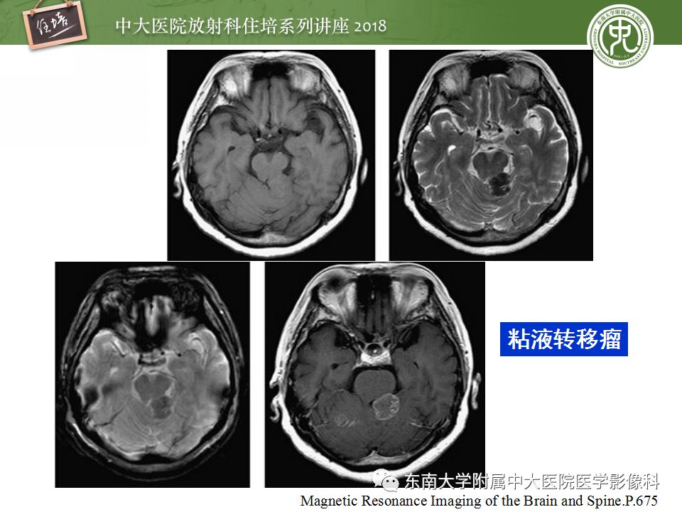 【PPT】脑内出血转归影像学表现
