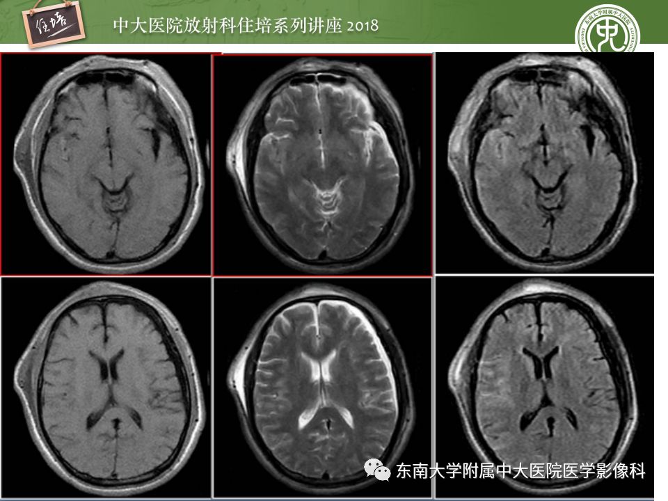 【PPT】脑内出血转归影像学表现