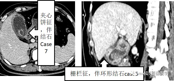 【PPT】黄色肉芽肿性胆囊炎