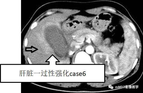 【PPT】黄色肉芽肿性胆囊炎