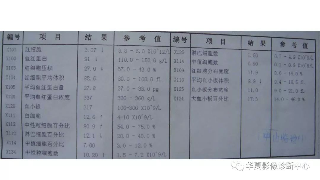 【病例】肺肉瘤样癌1例CT影像表现
