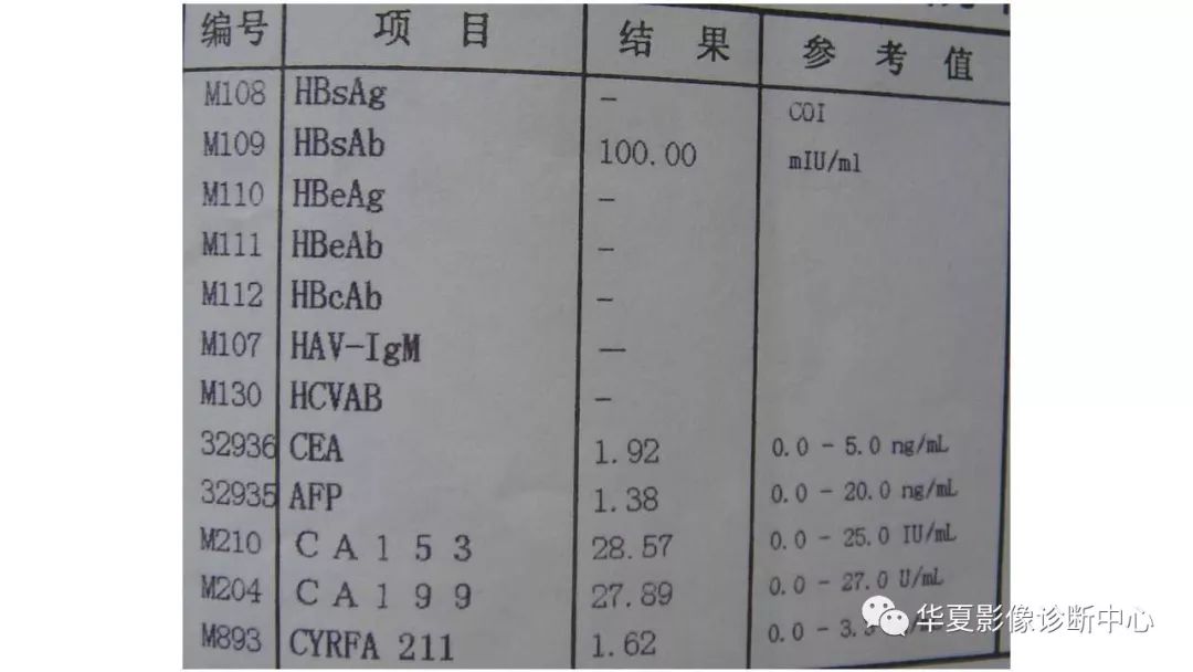 【病例】肺肉瘤样癌1例CT影像表现
