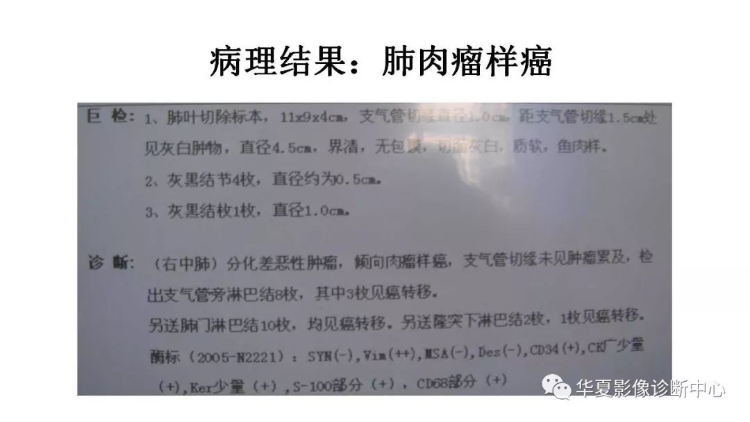 【病例】肺肉瘤样癌1例CT影像表现