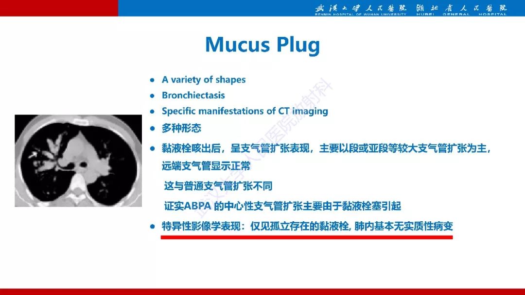 【PPT】变应性支气管肺曲霉病影像诊断