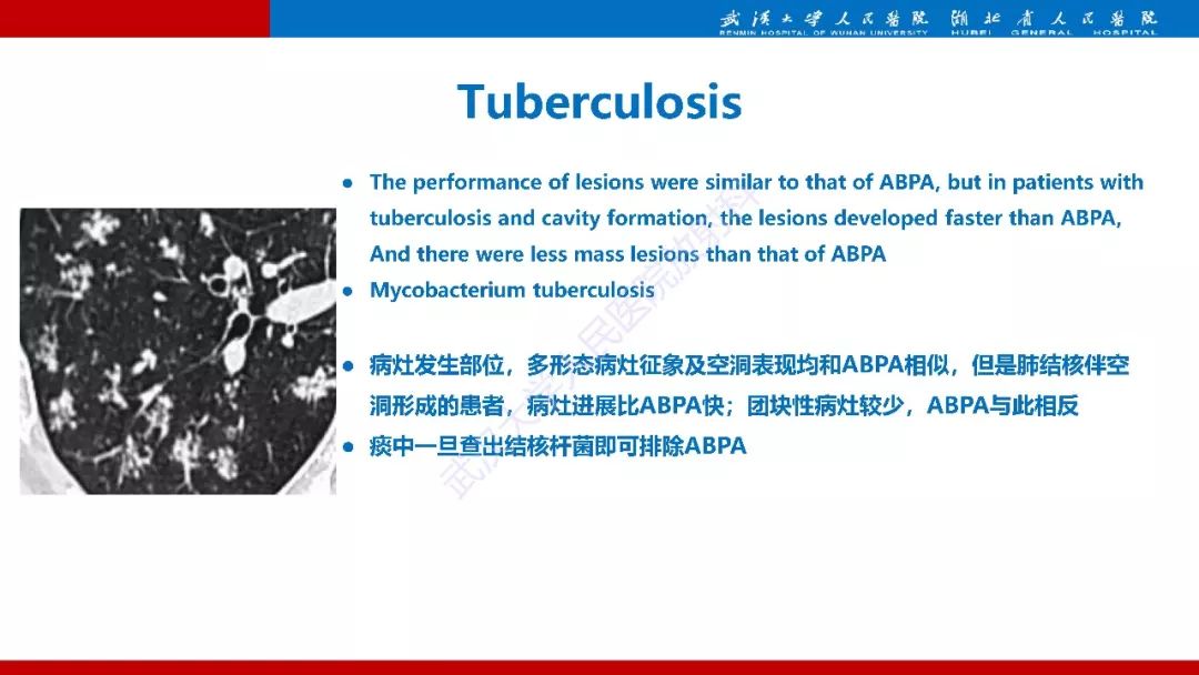 【PPT】变应性支气管肺曲霉病影像诊断