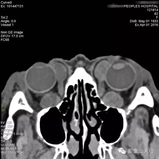 【病例】双侧永存副眼1例CT 【病例】双侧永存副眼1例CT